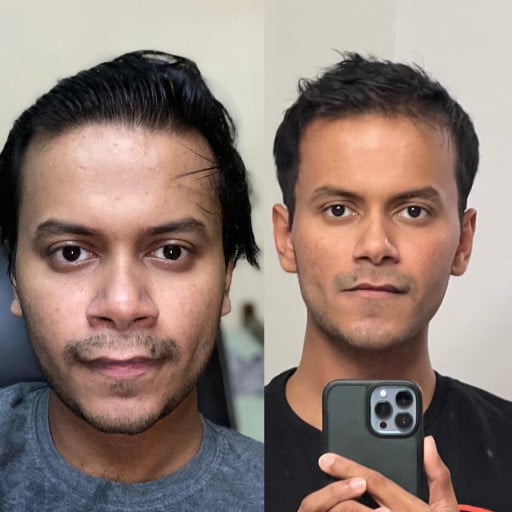 M/26/6’0 [182lbs - 160lbs] 2 years and wore overbite correcting braces.