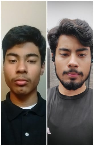 M/21/5'5" [110lbs > 130lbs = 20lbs] (5 years) This is how my face changed after getting braces and hitting the gym