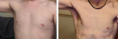 Before and After 21 lbs Weight Loss 5 foot 8 Male 178 lbs to 157 lbs