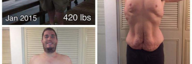 185 lbs Weight Loss Before and After 6 foot Male 420 lbs to 235 lbs