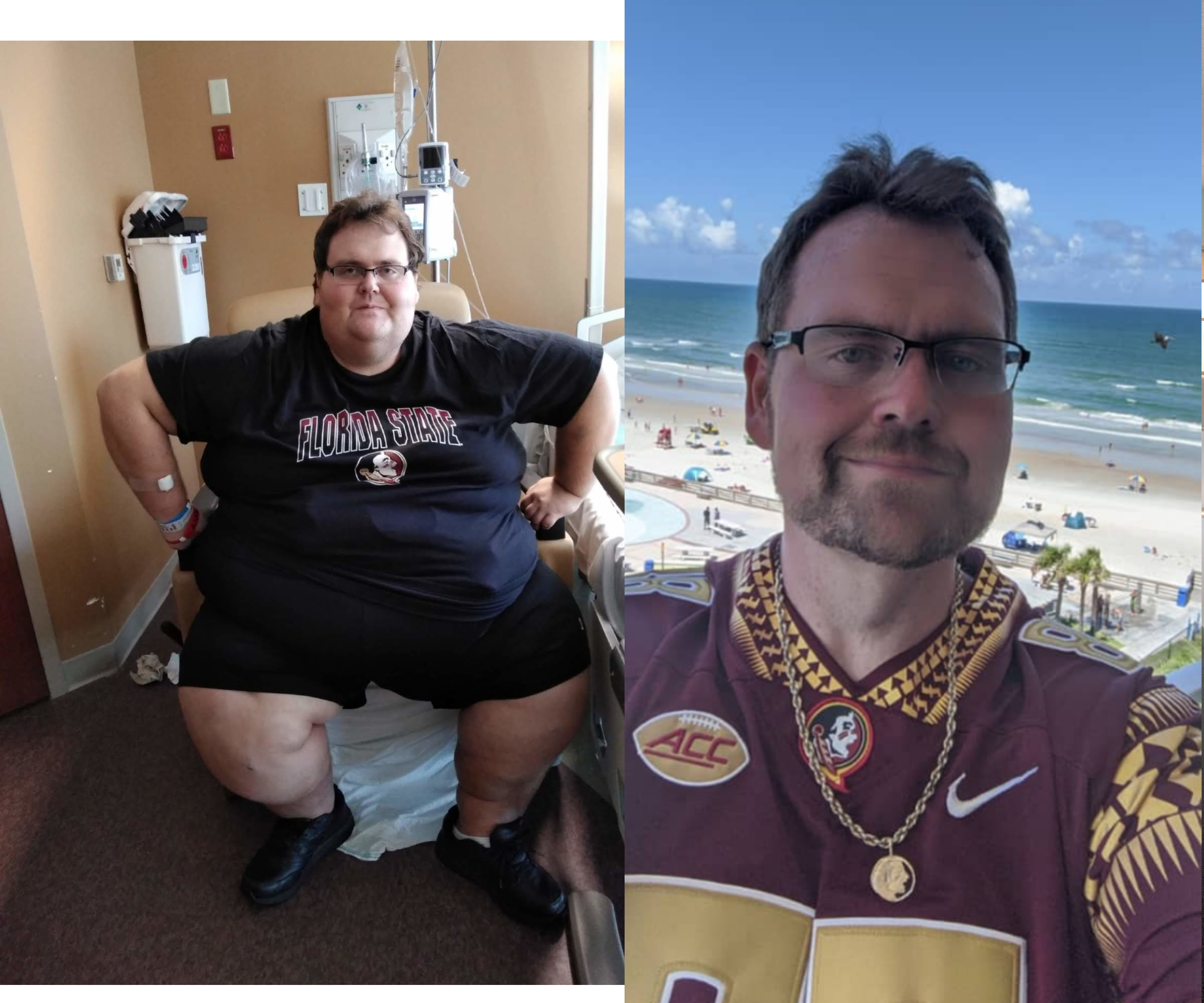 Progress Pics of 342 lbs Fat Loss 6 foot Male 587 lbs to 245 lbs
