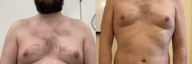5'11 Male Progress Pics of 23 lbs Fat Loss 215 lbs to 192 lbs