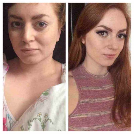 F/23's 85Lb Weight Loss Journey and Amazing Face Progress