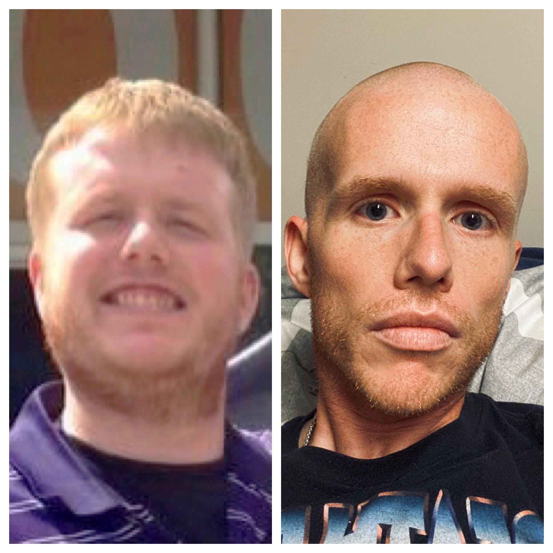 137 lbs Weight Loss 5'10 Male 315 lbs to 178 lbs