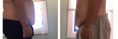 45 lbs Weight Loss 6 foot 1 Male 335 lbs to 290 lbs