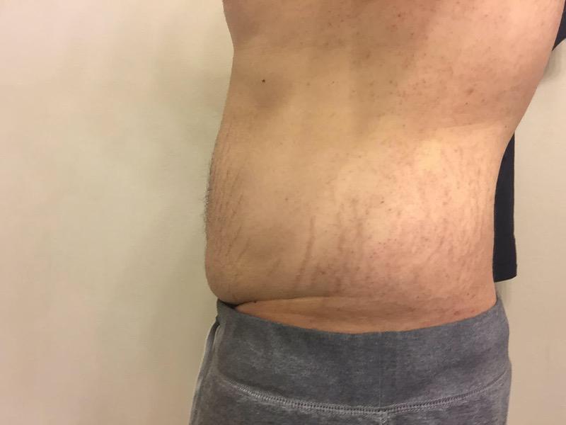 87 lbs Fat Loss 5 foot 8 Male 315 lbs to 228 lbs