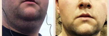 81 lbs Weight Loss Before and After 5 foot 9 Male 380 lbs to 299 lbs