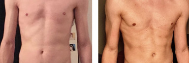 6'2 Male Before and After 33 lbs Weight Gain 137 lbs to 170 lbs