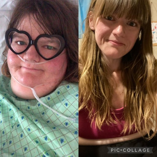 A before and after photo of a 5'6" female showing a weight reduction from 425 pounds to 175 pounds. A net loss of 250 pounds.