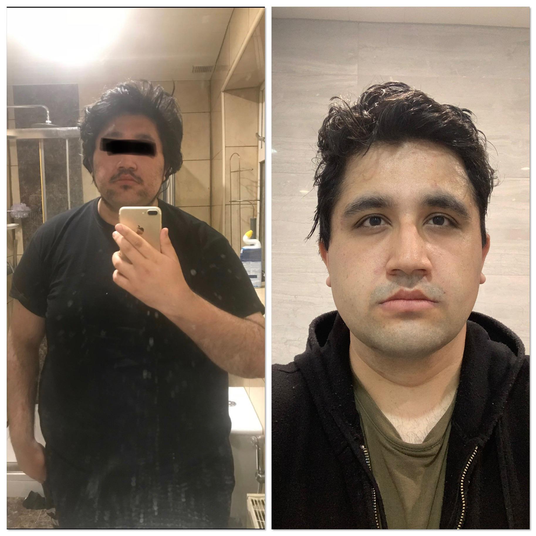 6'2 Male Progress Pics of 70 lbs Fat Loss 330 lbs to 260 lbs
