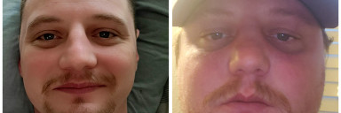 6 foot Male 55 lbs Fat Loss Before and After 265 lbs to 210 lbs