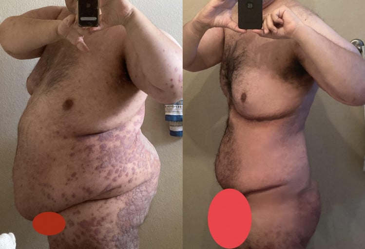 Before and After 217 lbs Weight Loss 6 foot 2 Male 477 lbs to 260 lbs