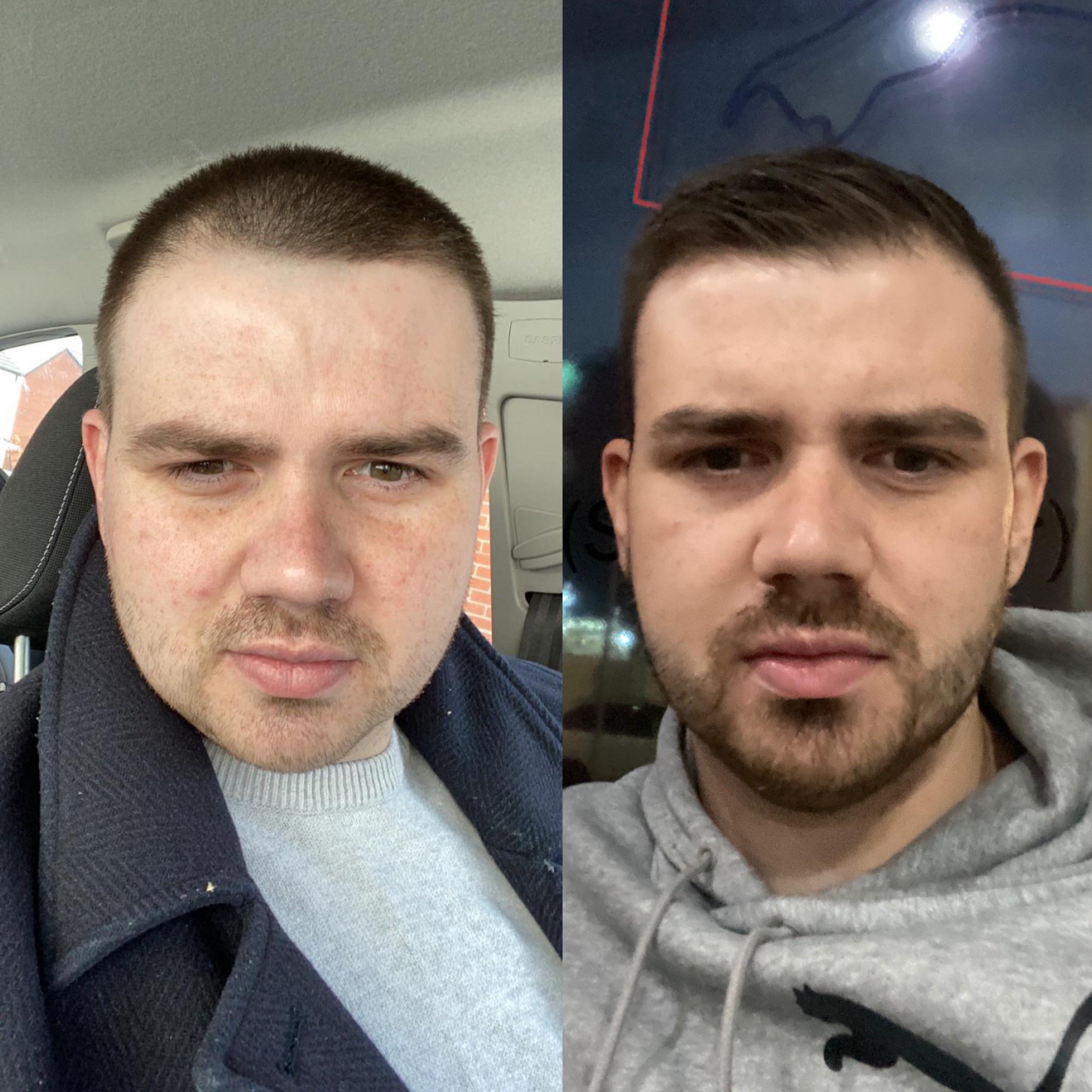 5 feet 10 Male Progress Pics of 61 lbs Fat Loss 276 lbs to 215 lbs