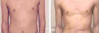 5 foot 10 Male 25 lbs Weight Loss 140 lbs to 115 lbs