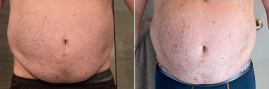 15 lbs Weight Loss Before and After 6 foot Male 320 lbs to 305 lbs