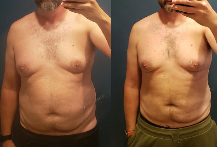 6'1 Male Before and After 22 lbs Fat Loss 240 lbs to 218 lbs