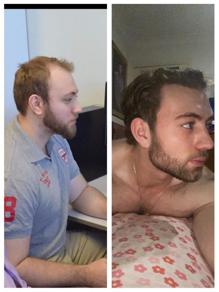 Before and After 98 lbs Fat Loss 6 foot Male 308 lbs to 210 lbs