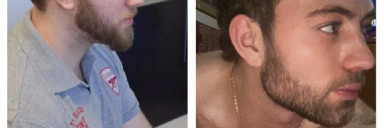 Before and After 98 lbs Fat Loss 6 foot Male 308 lbs to 210 lbs