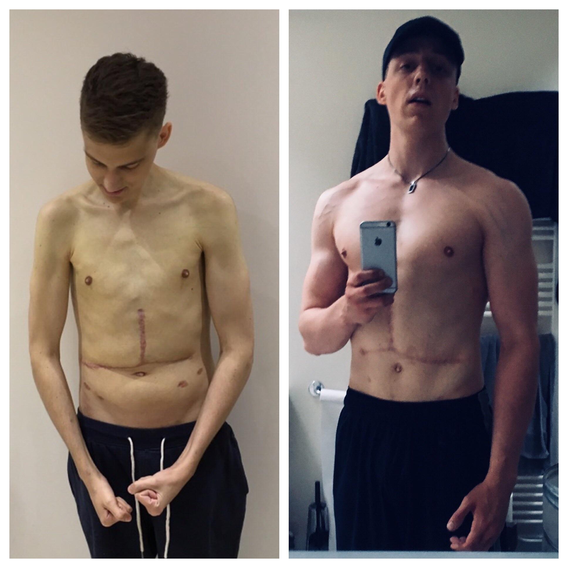 6 foot 3 Male 75 lbs Weight Gain Before and After 112 lbs to 187 lbs