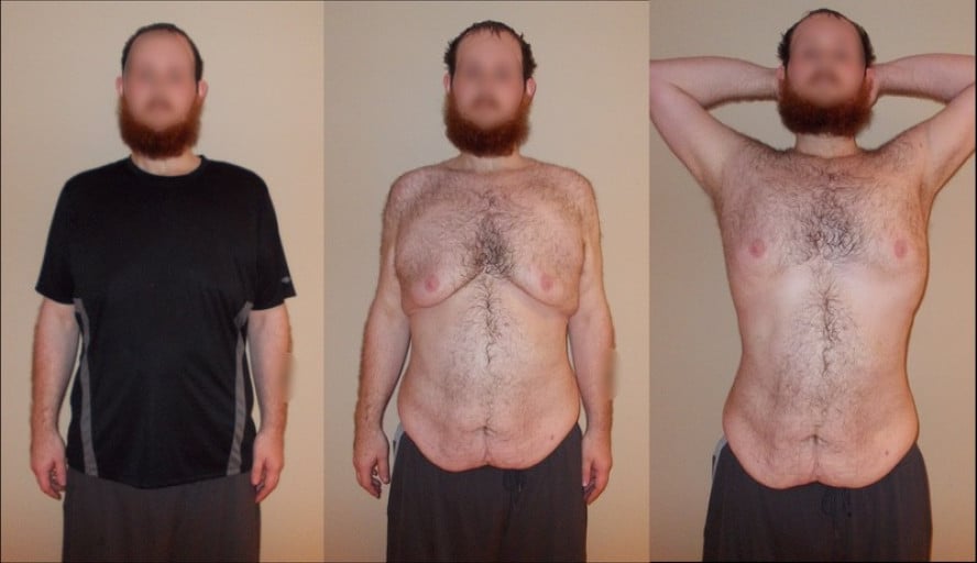A progress pic of a 6'1" man showing a weight loss from 330 pounds to 232 pounds. A net loss of 98 pounds.