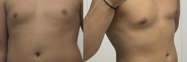 Progress Pics of 18 lbs Weight Loss 5 feet 9 Male 198 lbs to 180 lbs