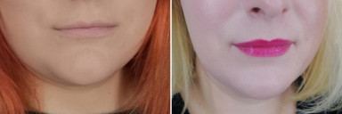 5 feet 8 Female Before and After 68 lbs Weight Loss 330 lbs to 262 lbs